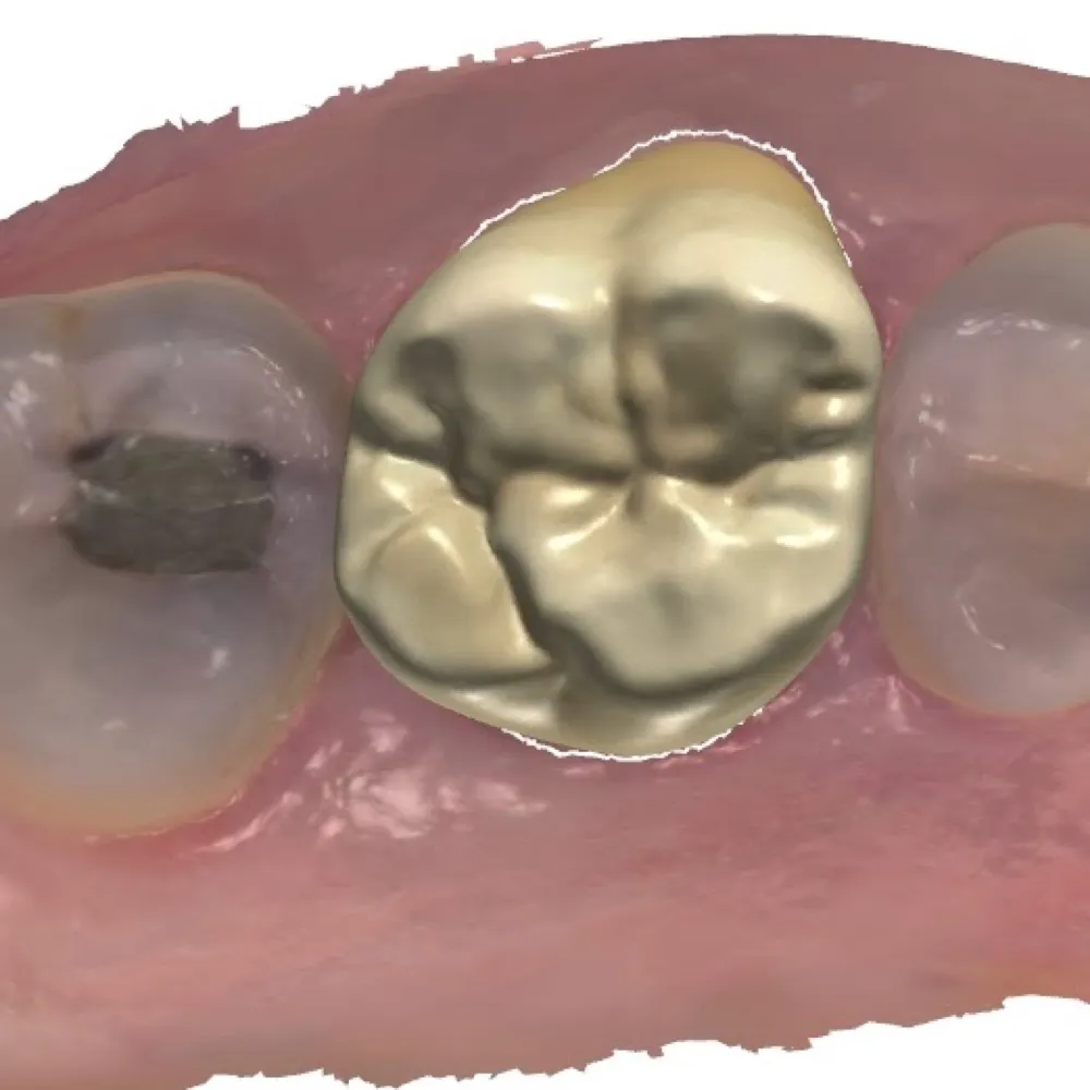 Digital Dental Design Outsourcing Services