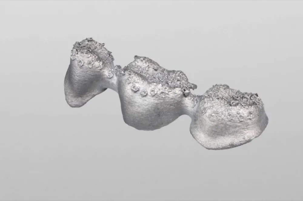 SLM - Single coping or Coping bridge unfinished